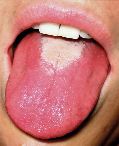 Glossy, Smooth, or Inflamed Tongue (image credits: wikimedia)