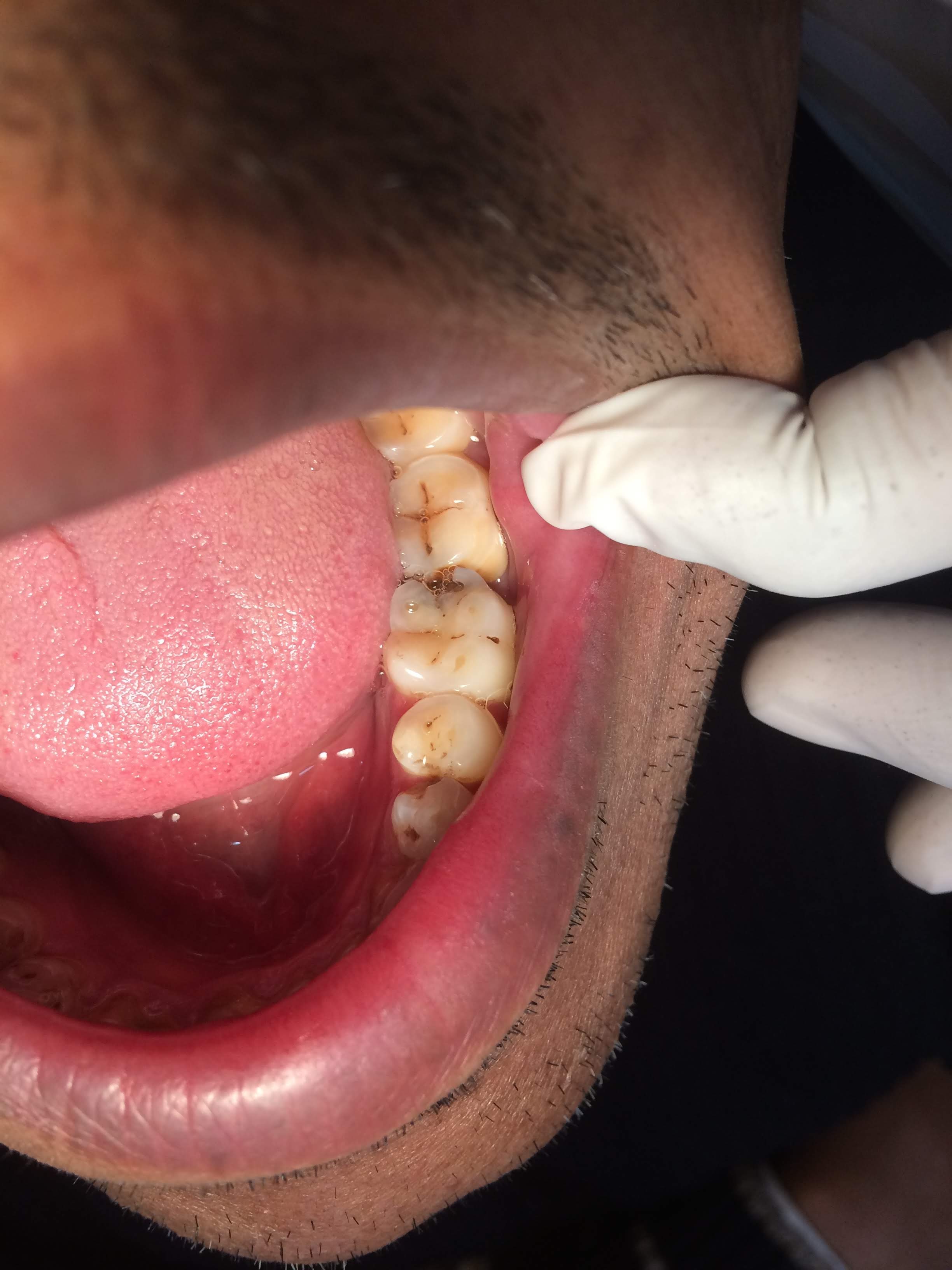 Dental Problems: More Cavities and Sensitivity (image credits: wikimedia)