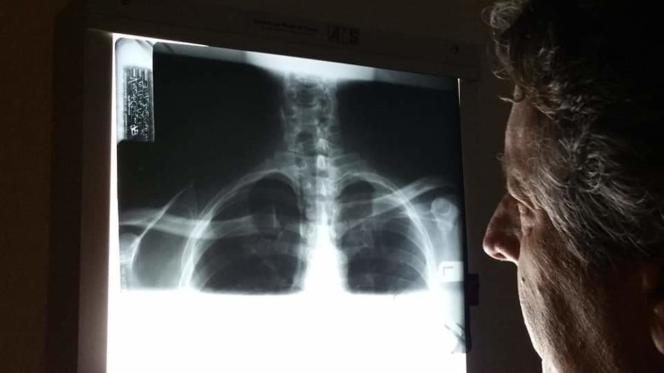 Bone Health Issues and Increased Fracture Risk (image credits: flickr)