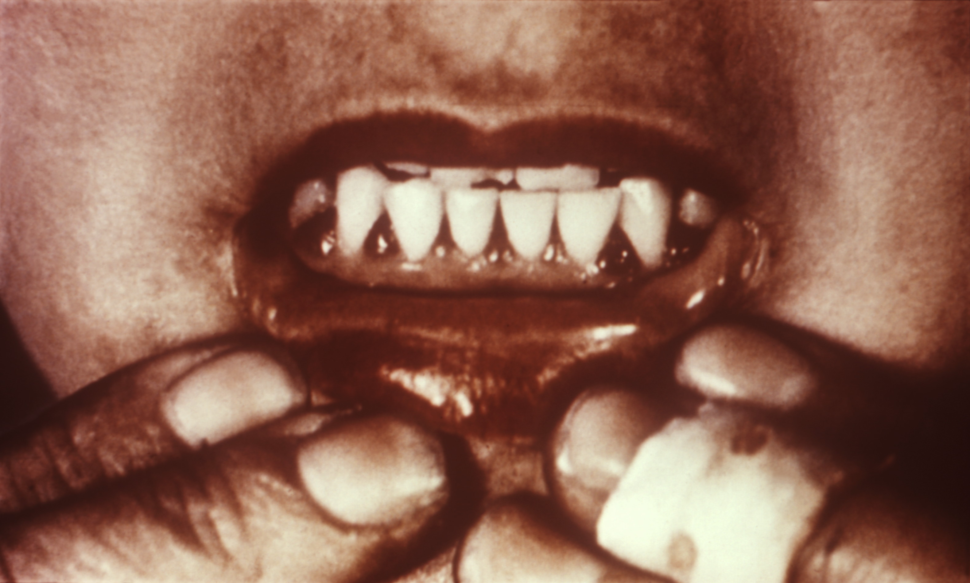 Bleeding Gums: More Than a Dental Problem (Vitamin C Deficiency) (image credits: wikimedia)