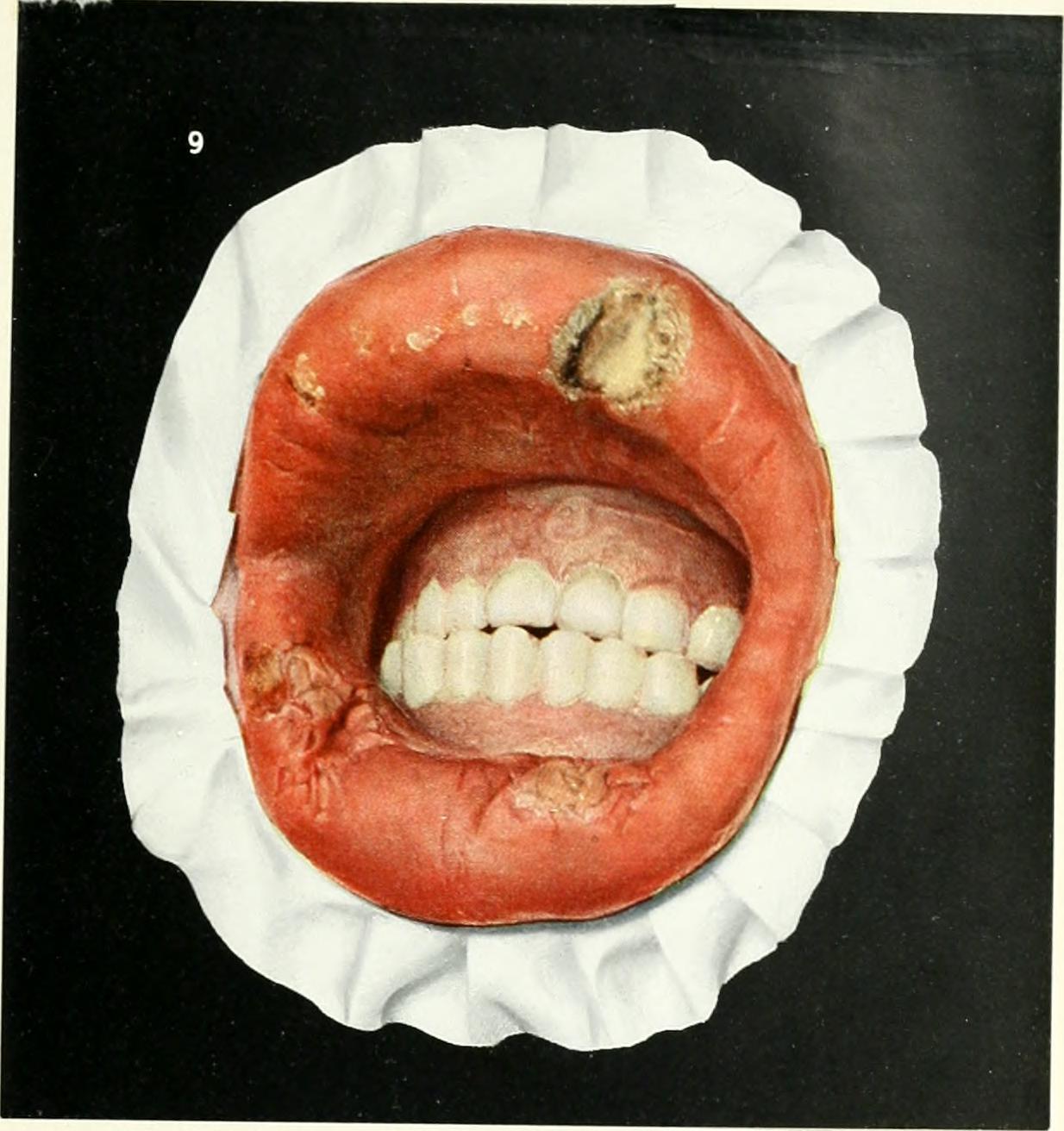 Mouth Ulcers and a Swollen Tongue (image credits: wikimedia)