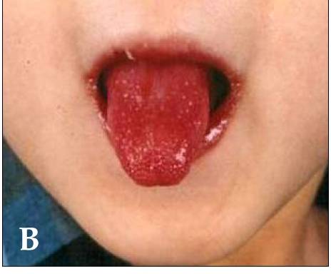 Glossitis (Swollen, Red Tongue) (image credits: wikimedia)