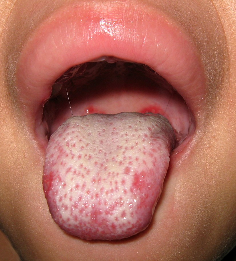 5. Glossitis and Mouth Ulcers (image credits: wikimedia)