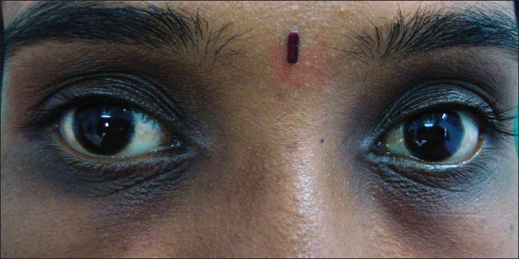 Dark Circles and Dull Skin (image credits: wikimedia)
