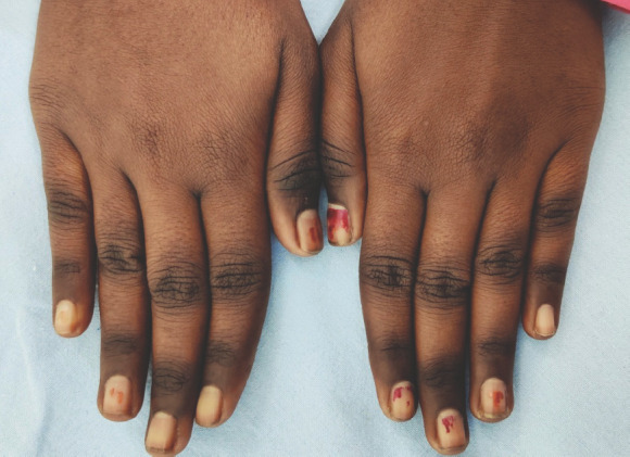Pale or Jaundiced Skin (image credits: wikimedia)