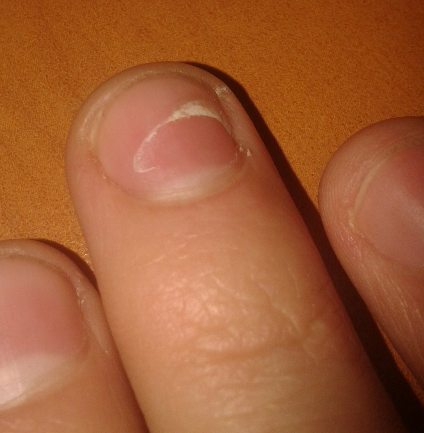 Brittle Nails (image credits: wikimedia)