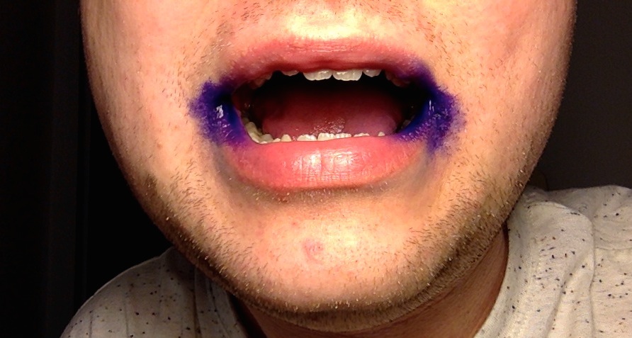 5. Cracked Mouth Corners: B Vitamin Deficiency Revealed (image credits: wikimedia)