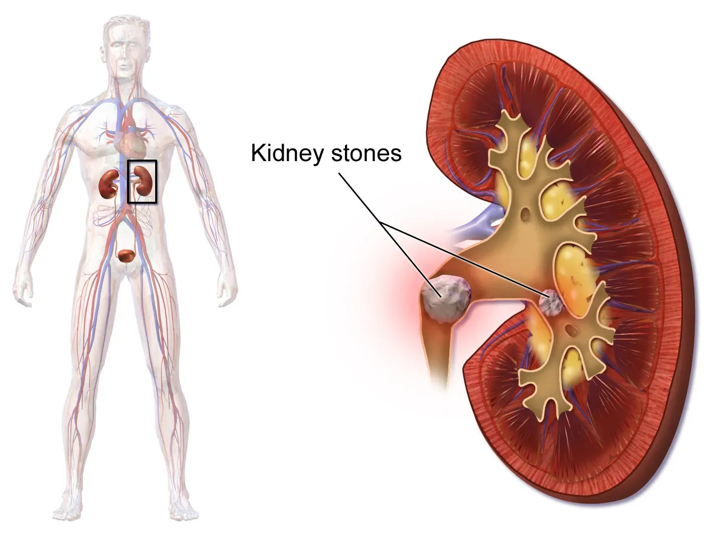 The Kidney Stone Connection Most People Ignore (By BruceBlaus. When using this image in external sources it can be cited as:

Blausen.com staff (2014). "Medical gallery of Blausen Medical 2014". WikiJournal of Medicine 1 (2). DOI:10.15347/wjm/2014.010. ISSN 2002-4436., CC BY 3.0)