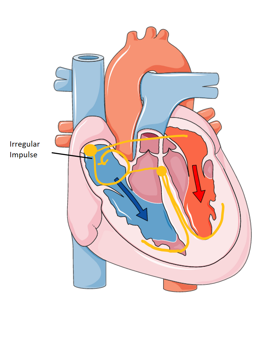 Irregular Heartbeat (image credits: wikimedia)