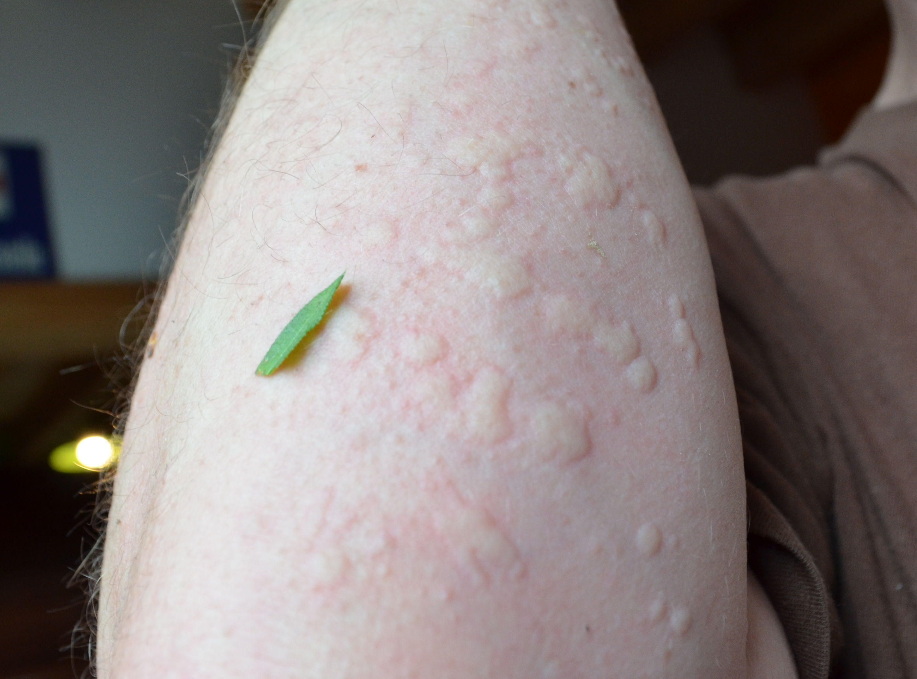 Your Skin's Silent Scream for Help (image credits: wikimedia)