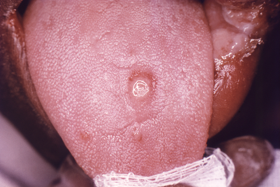 5. Glossitis and Mouth Ulcers (image credits: wikimedia)