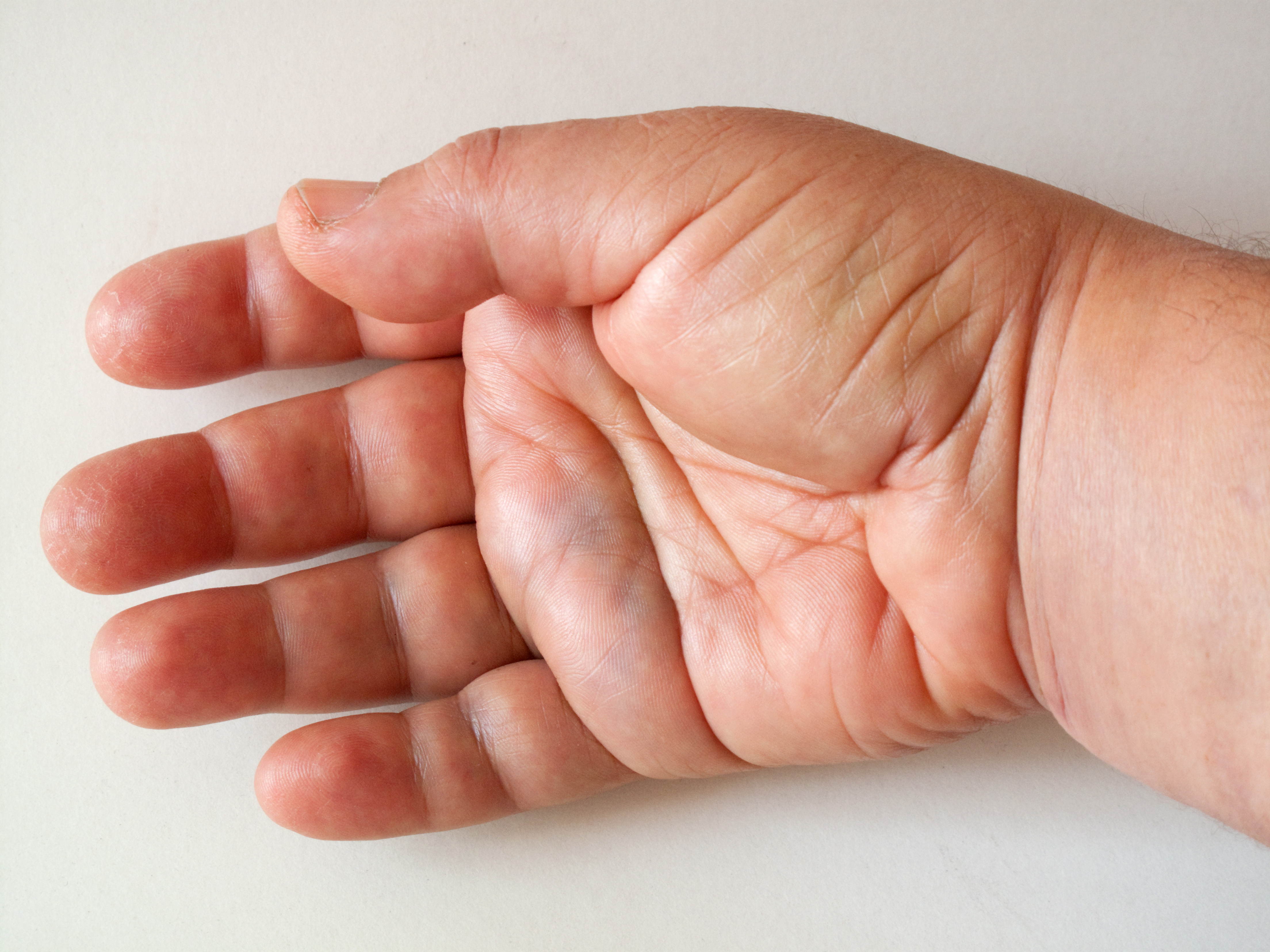 Fluid Retention and Swelling: Feeling Puffy and Uncomfortable (image credits: wikimedia)
