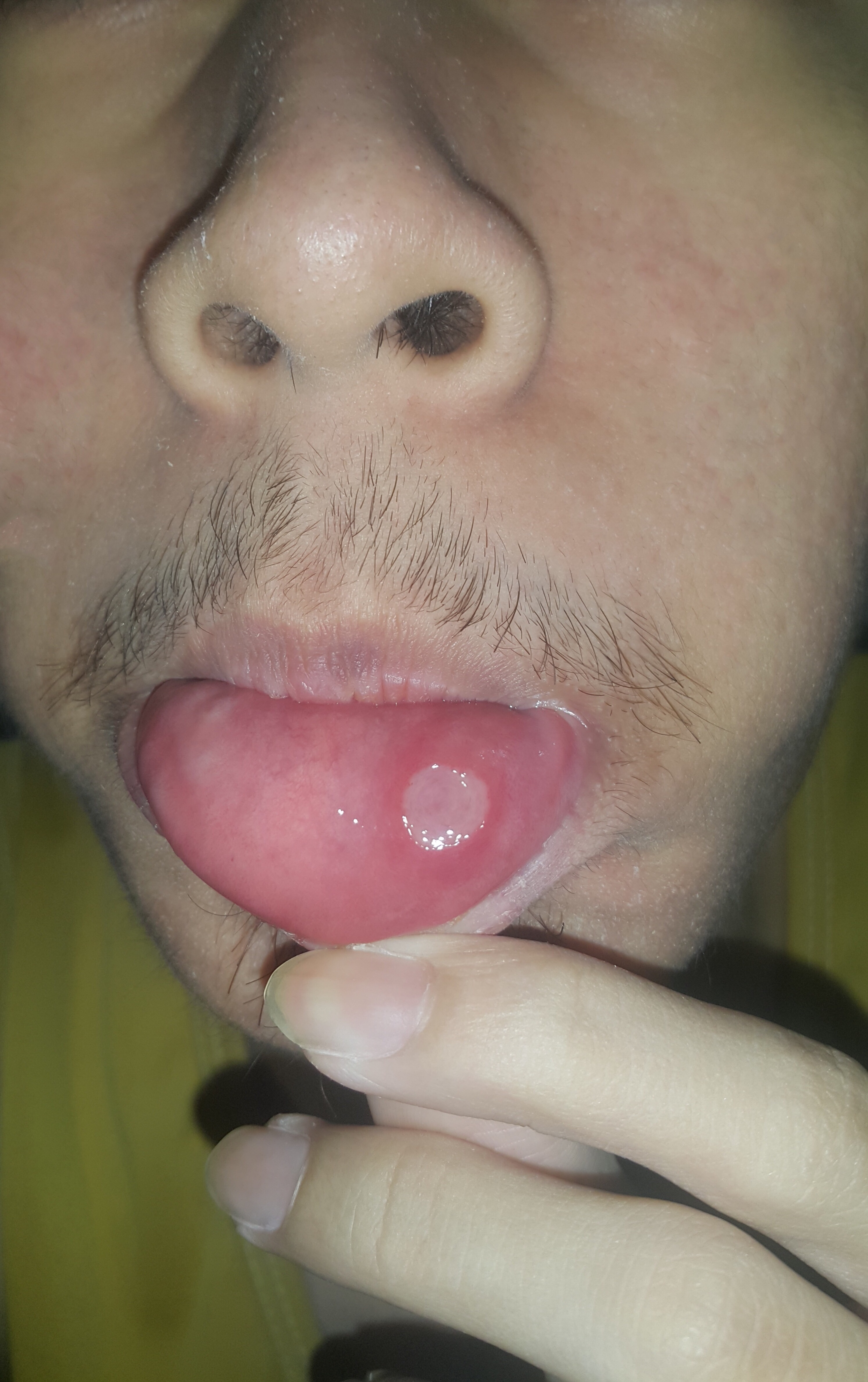Glossitis and Mouth Ulcers (image credits: wikimedia)