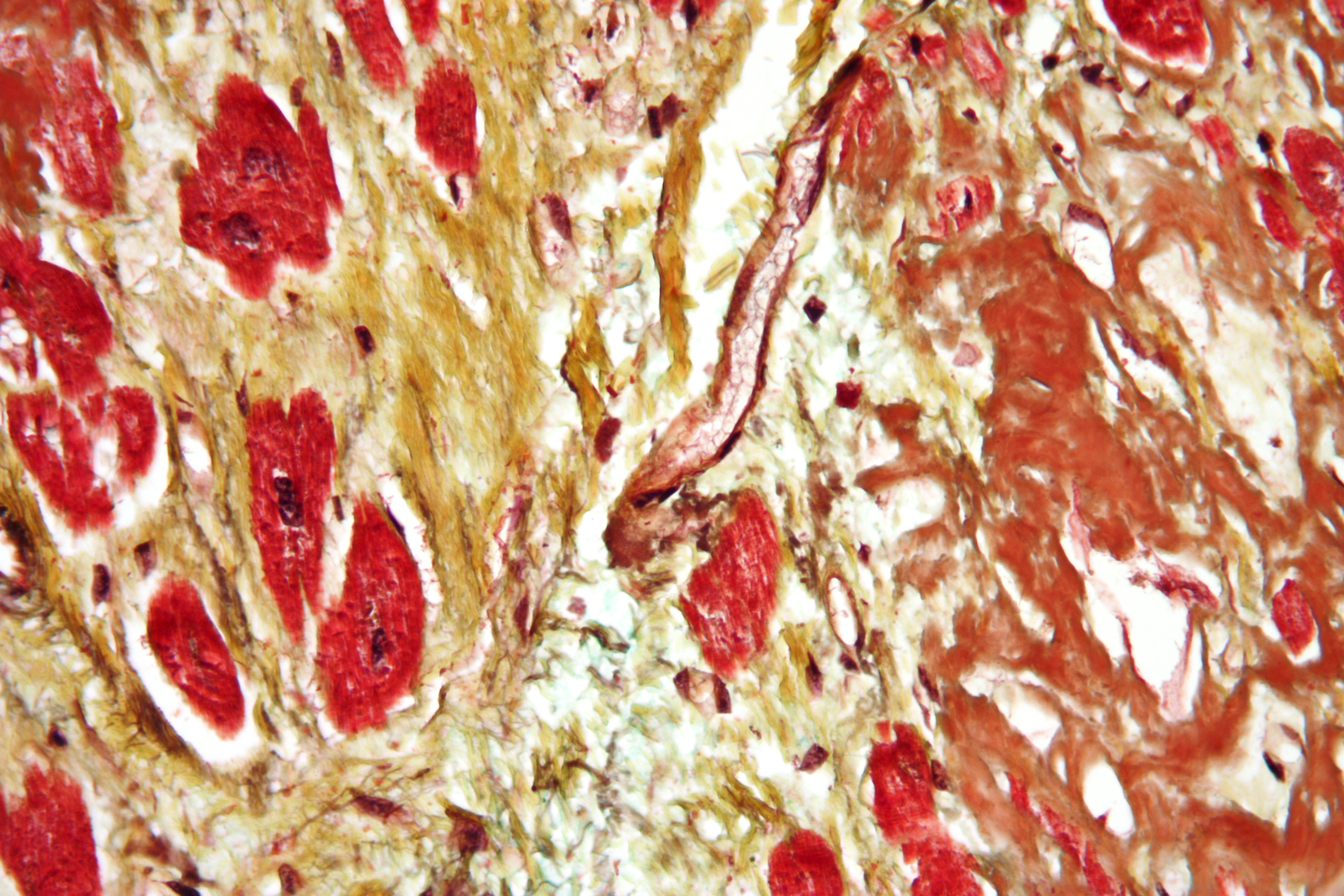 Risk of Heart Disease Increases (image credits: wikimedia)