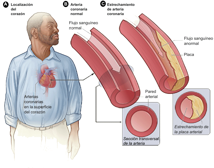 The Silent Killer Creeping Through Your Arteries (image credits: wikimedia)