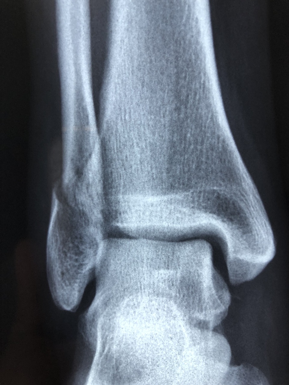 Frequent Bone Fractures and Slow Healing (image credits: pixabay)