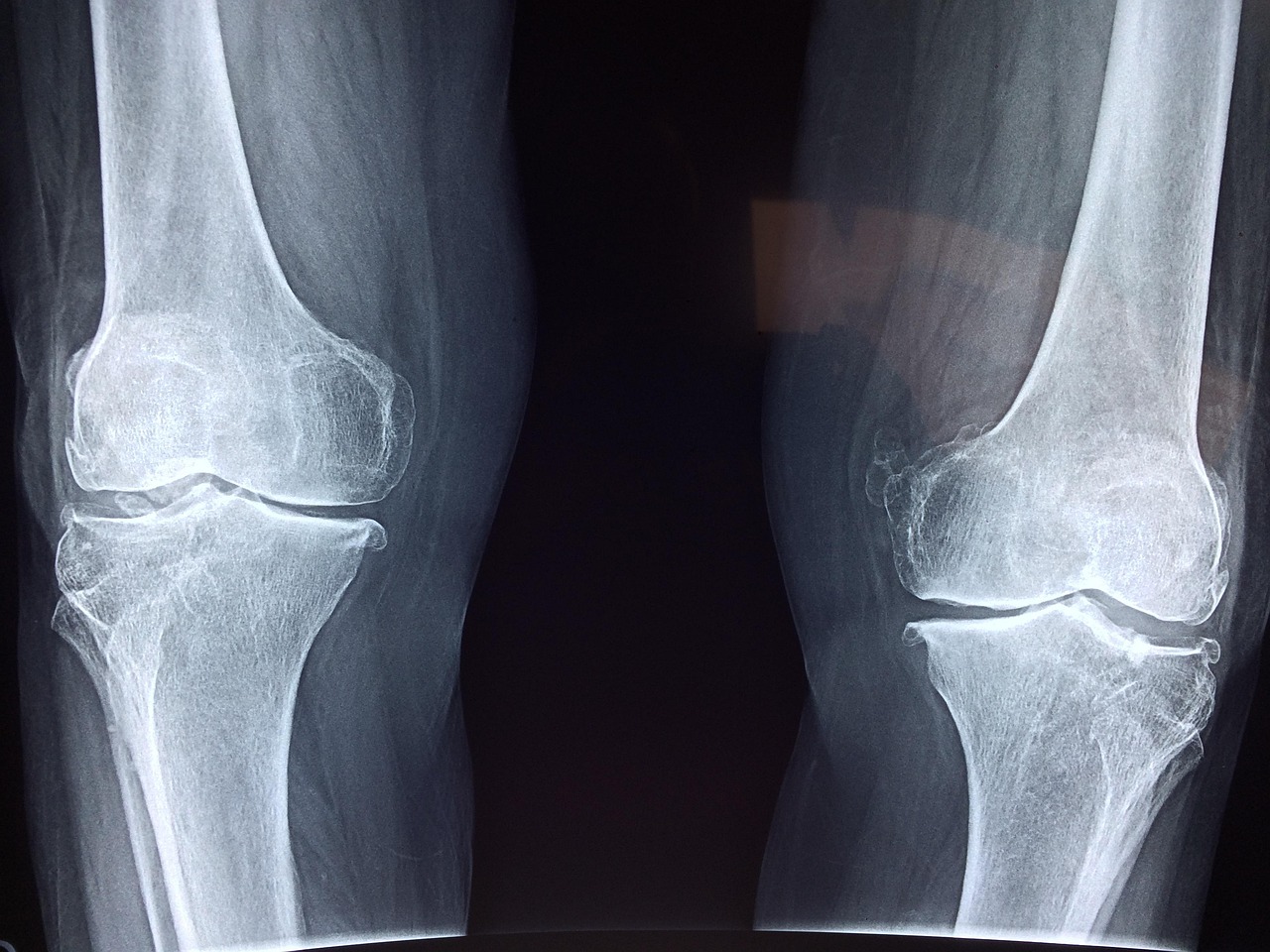 Osteoporosis Risk (image credits: pixabay)