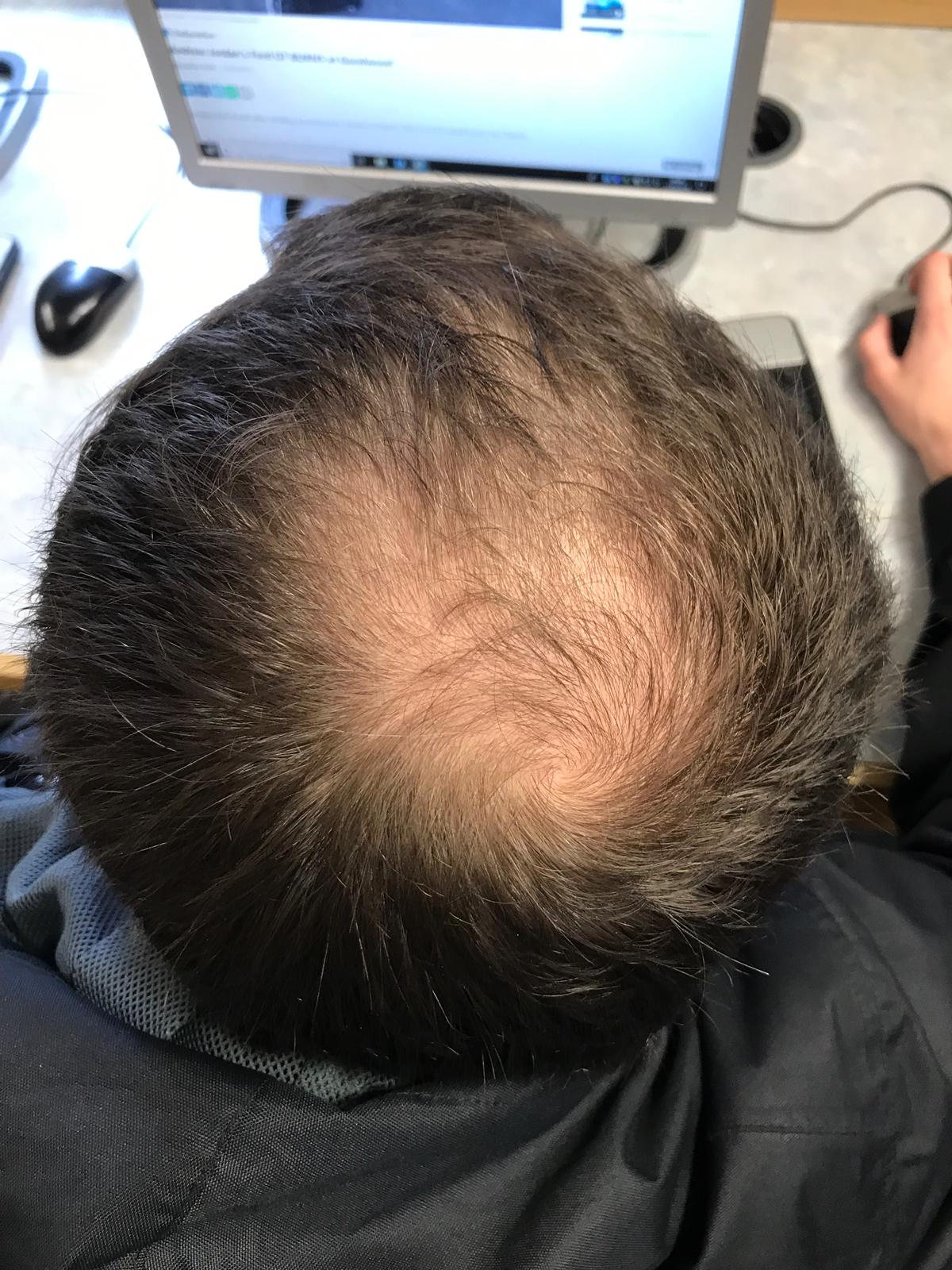 2. Brittle Nails and Hair Loss: The Biotin and Zinc Connection (image credits: wikimedia)