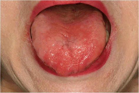 B12 Deficiency: A Growing Global Concern (image credits: wikimedia)