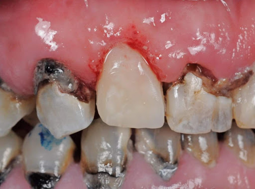Your Teeth Become Sitting Ducks for Decay (image credits: wikimedia)