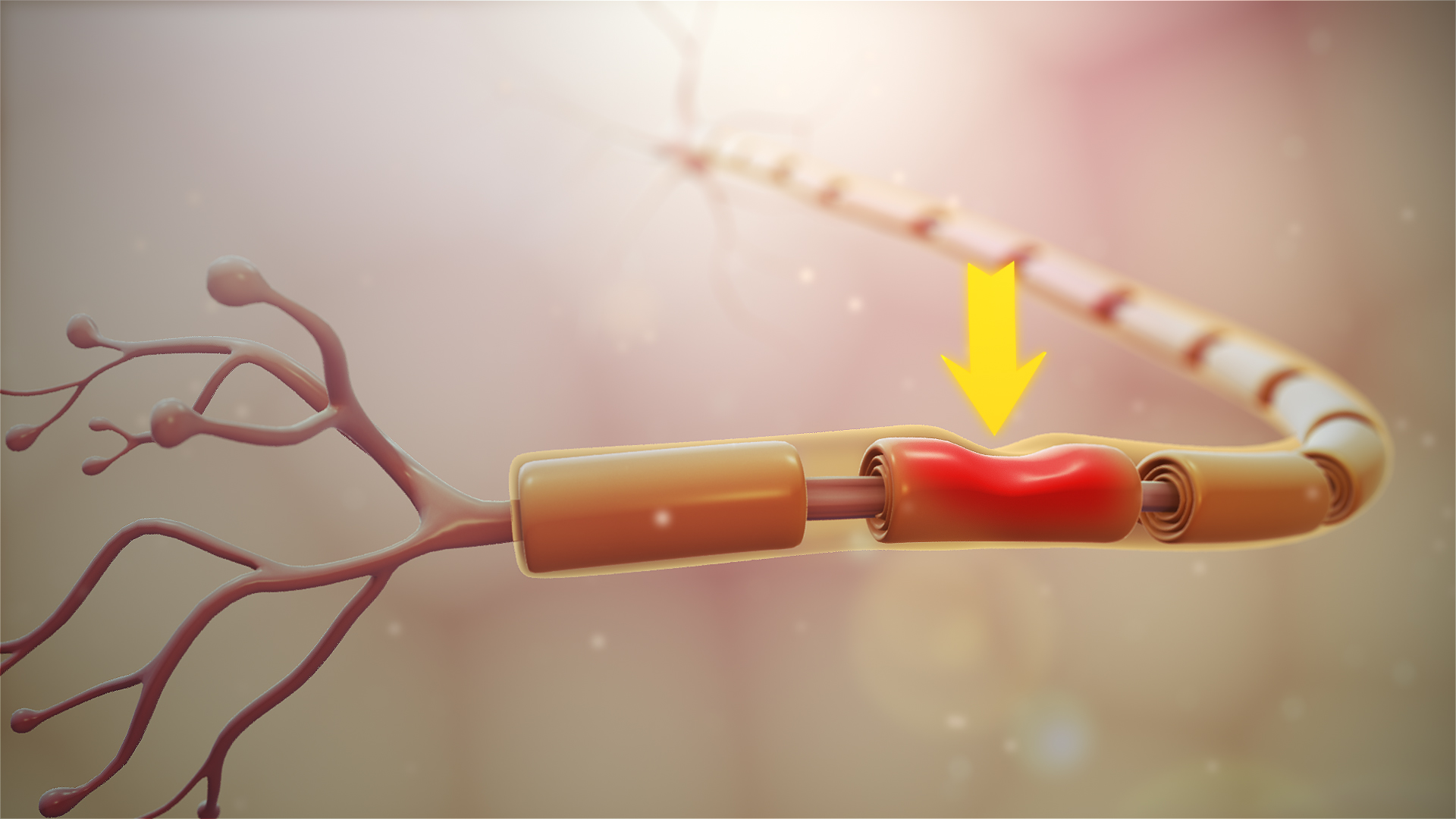 Nerve Damage (image credits: wikimedia)