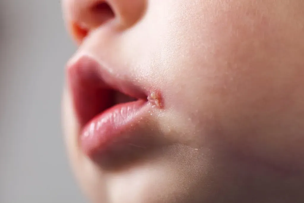 9. Inflamed or Swollen Tongue (Glossitis) and Mouth Sores (juandbarlow, Flickr, CC BY-SA 2.0)