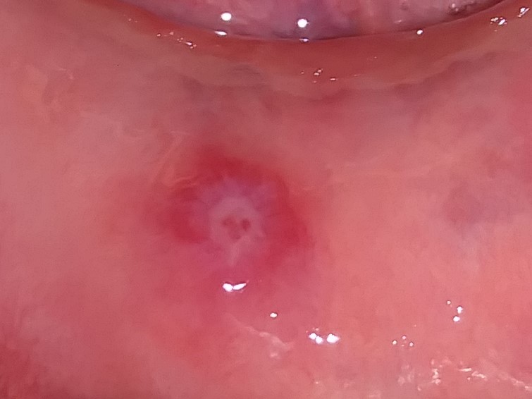 Glossitis and Mouth Ulcers (image credits: wikimedia)