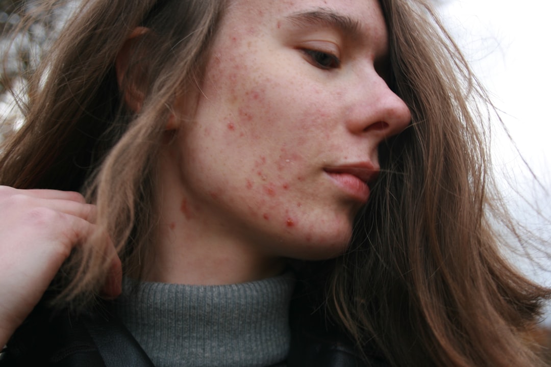 Your Skin Breaks Out More Than a Teenager (image credits: unsplash)