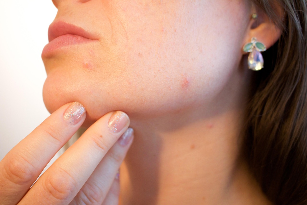 Skin Breakouts and Acne Surges (image credits: pixabay)