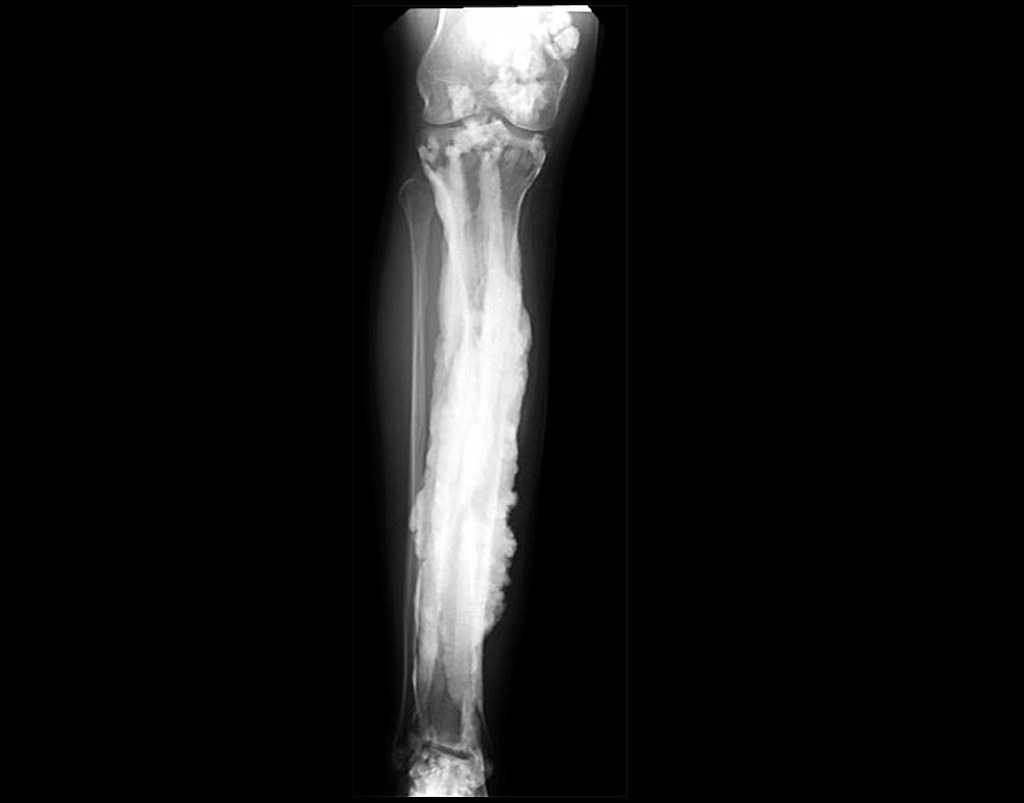 Weak Bones Despite Adequate Calcium Intake (image credits: flickr)