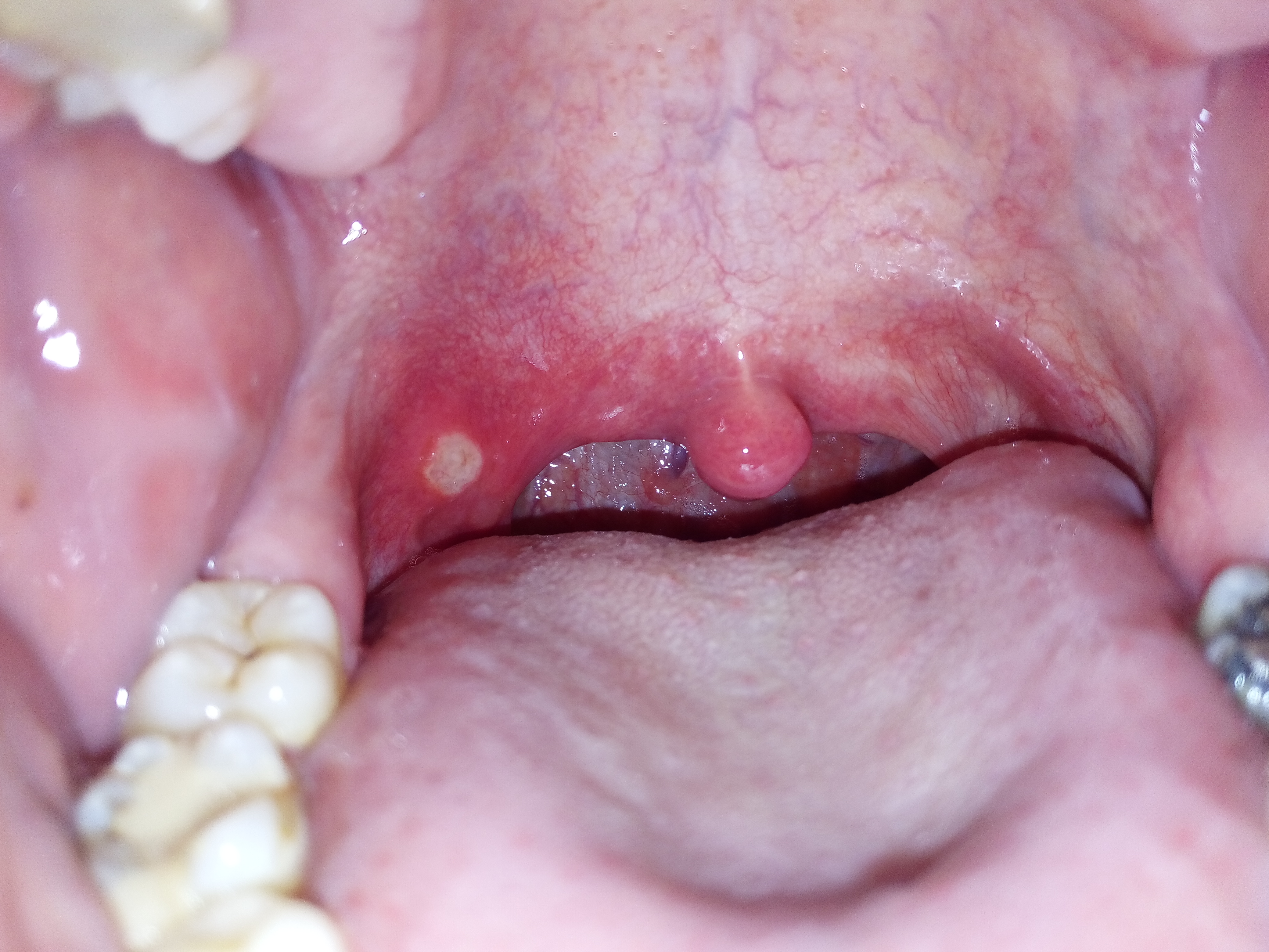 Glossitis and Mouth Ulcers: When Eating Hurts (image credits: wikimedia)