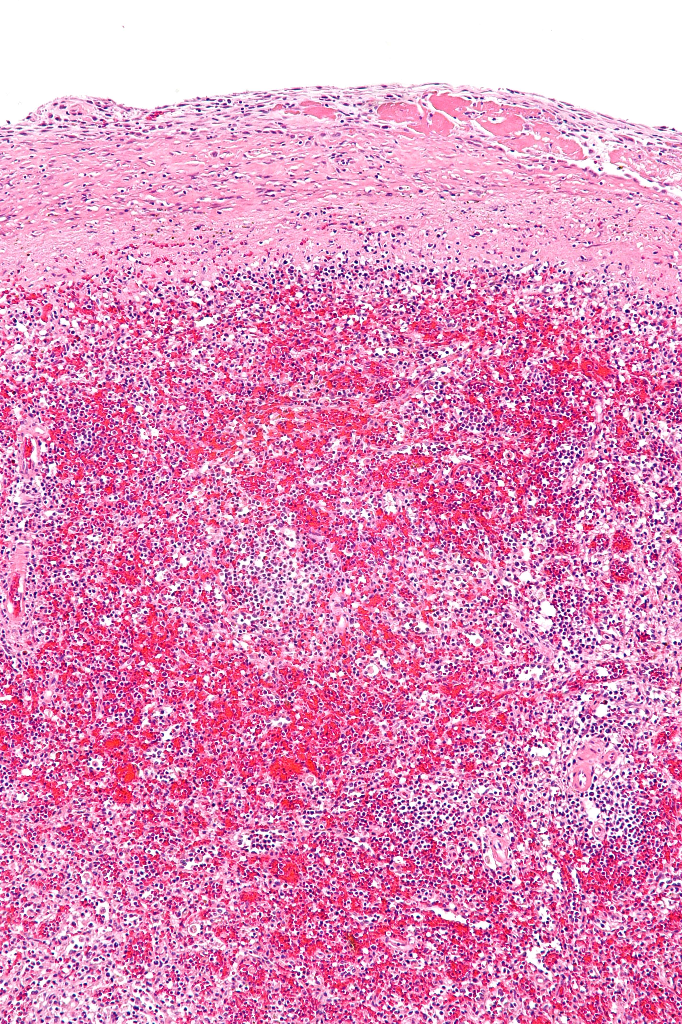 Sugar and Neuroinflammation (image credits: wikimedia)