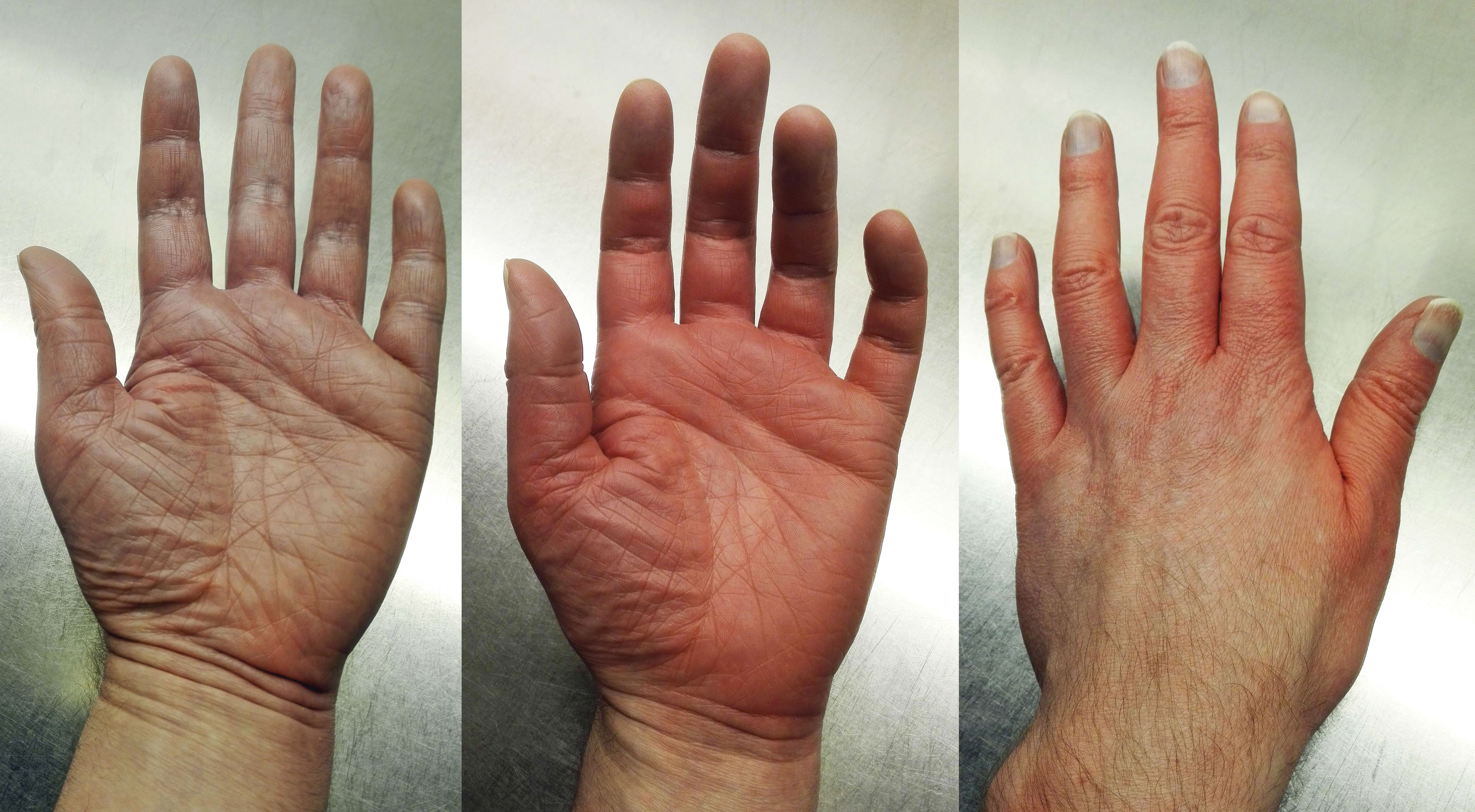 Tingling Hands and Feet: The Nerve Rattler (Vitamin B12 or B9 Deficiency) (image credits: wikimedia)