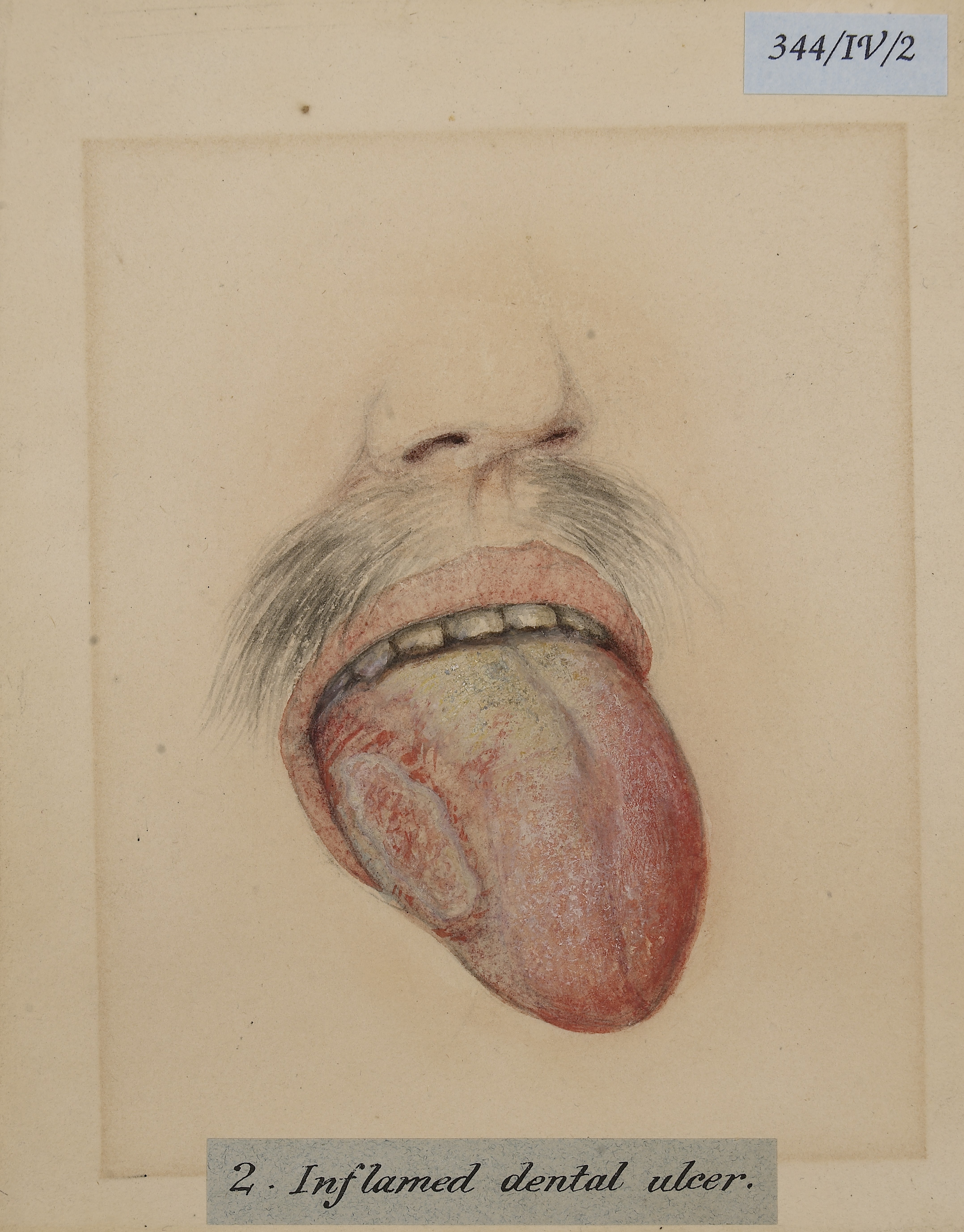 5. Glossitis and Mouth Ulcers: Oral Signs You Can’t Ignore (image credits: wikimedia)