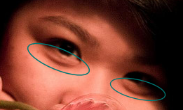 Puffy Eyes and Dark Circles (image credits: wikimedia)