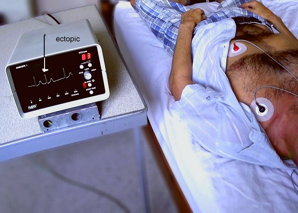 Irregular Heartbeat and Chest Flutters (image credits: flickr)