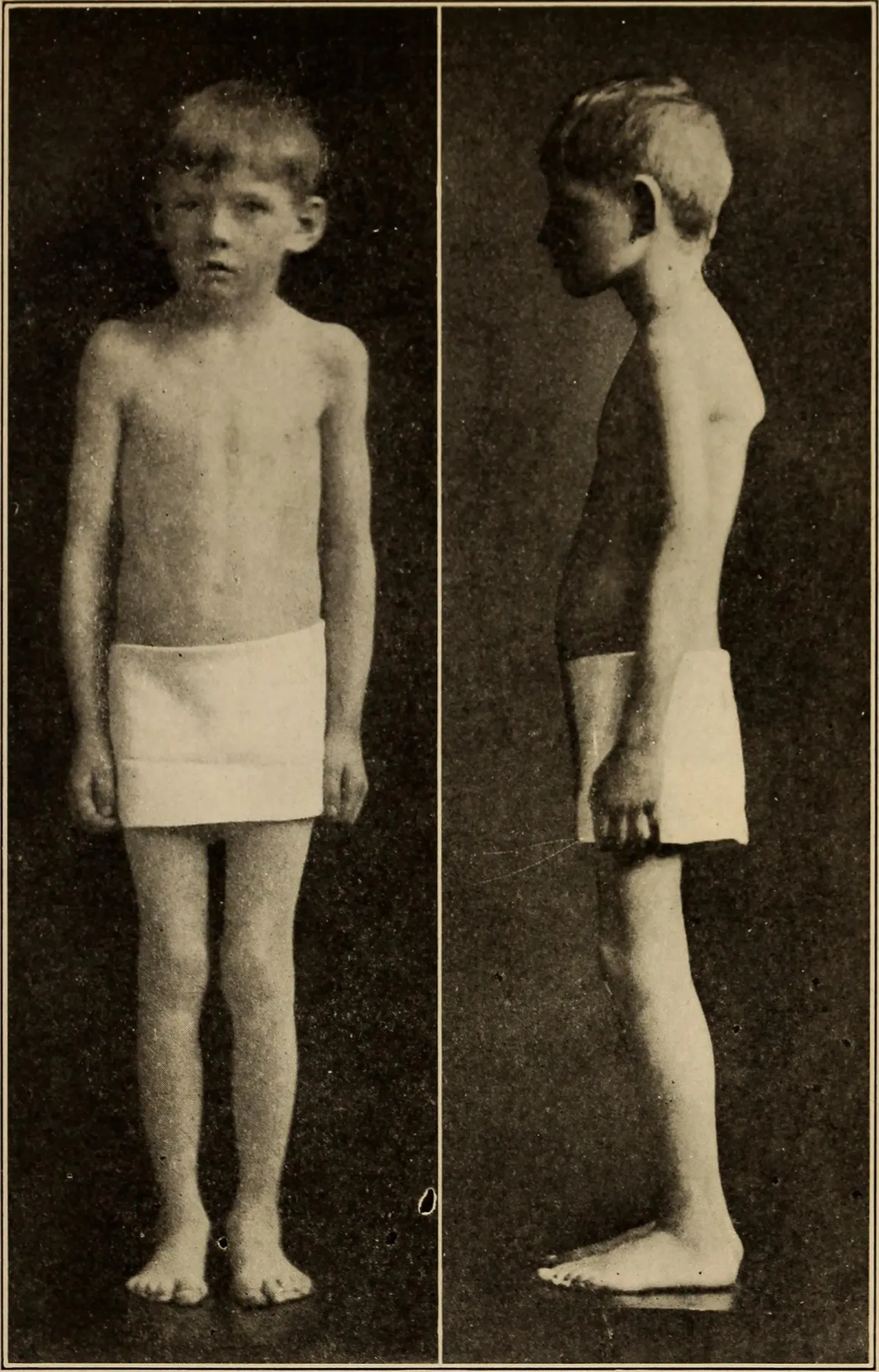 The Physical Toll: Nutritional Deficiencies Nobody Warns You About (Image Credits: Wikimedia)
