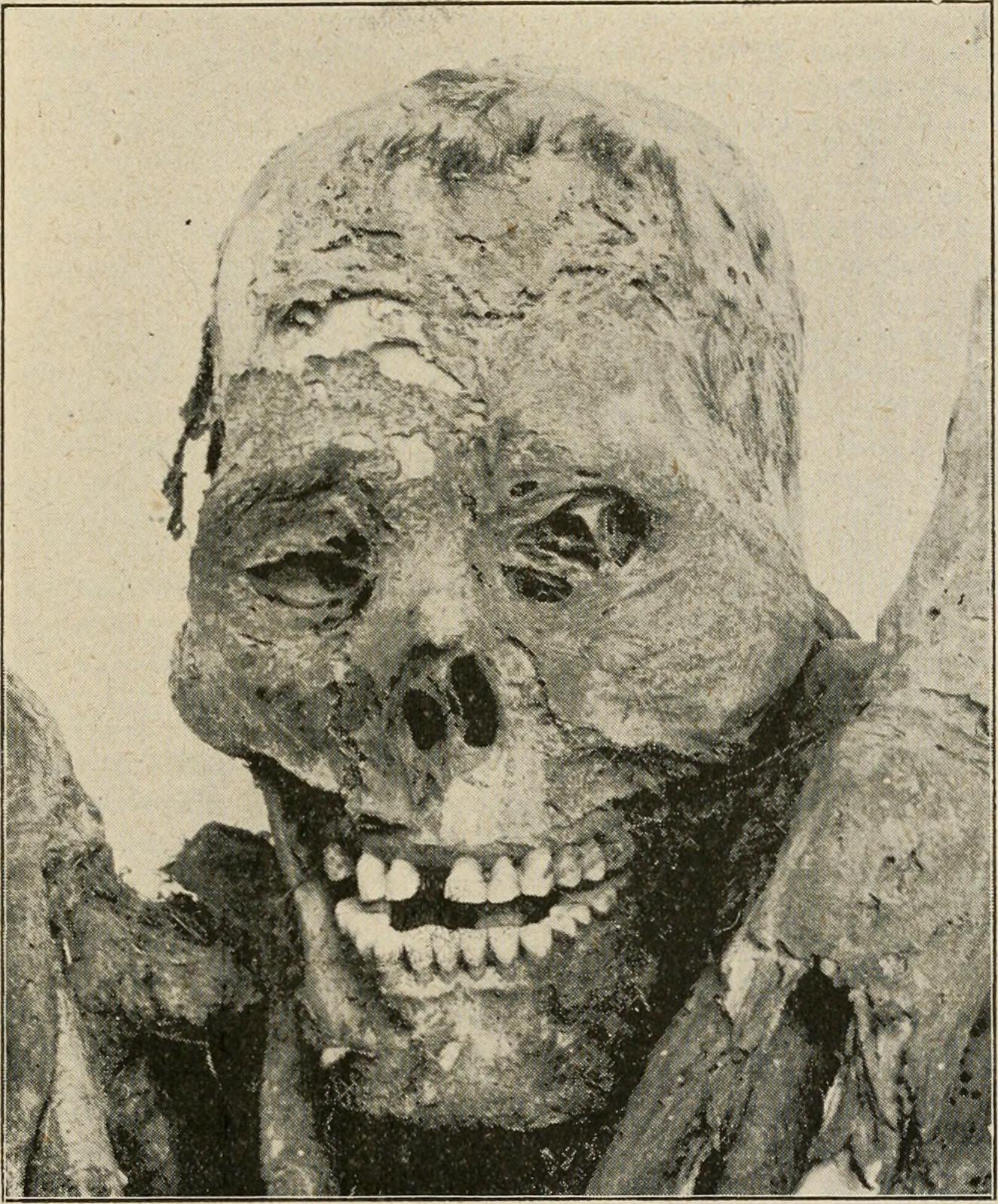 Leprosy in Pre-Columbian America: Disease History Rewritten (image credits: wikimedia)