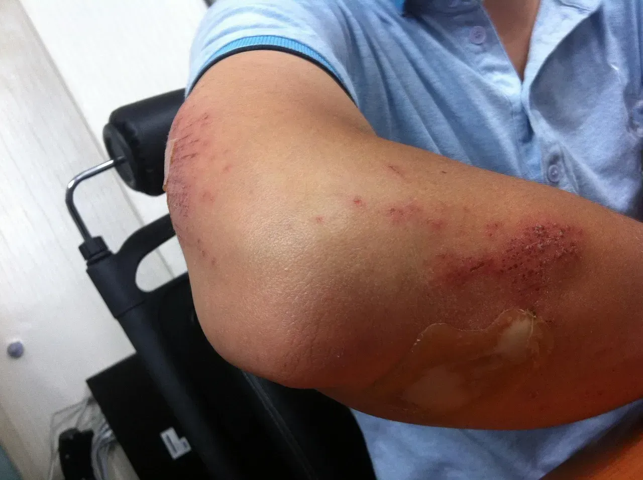 Unexplained Bruises or Falls They Brush Off (Image Credits: Pixabay)