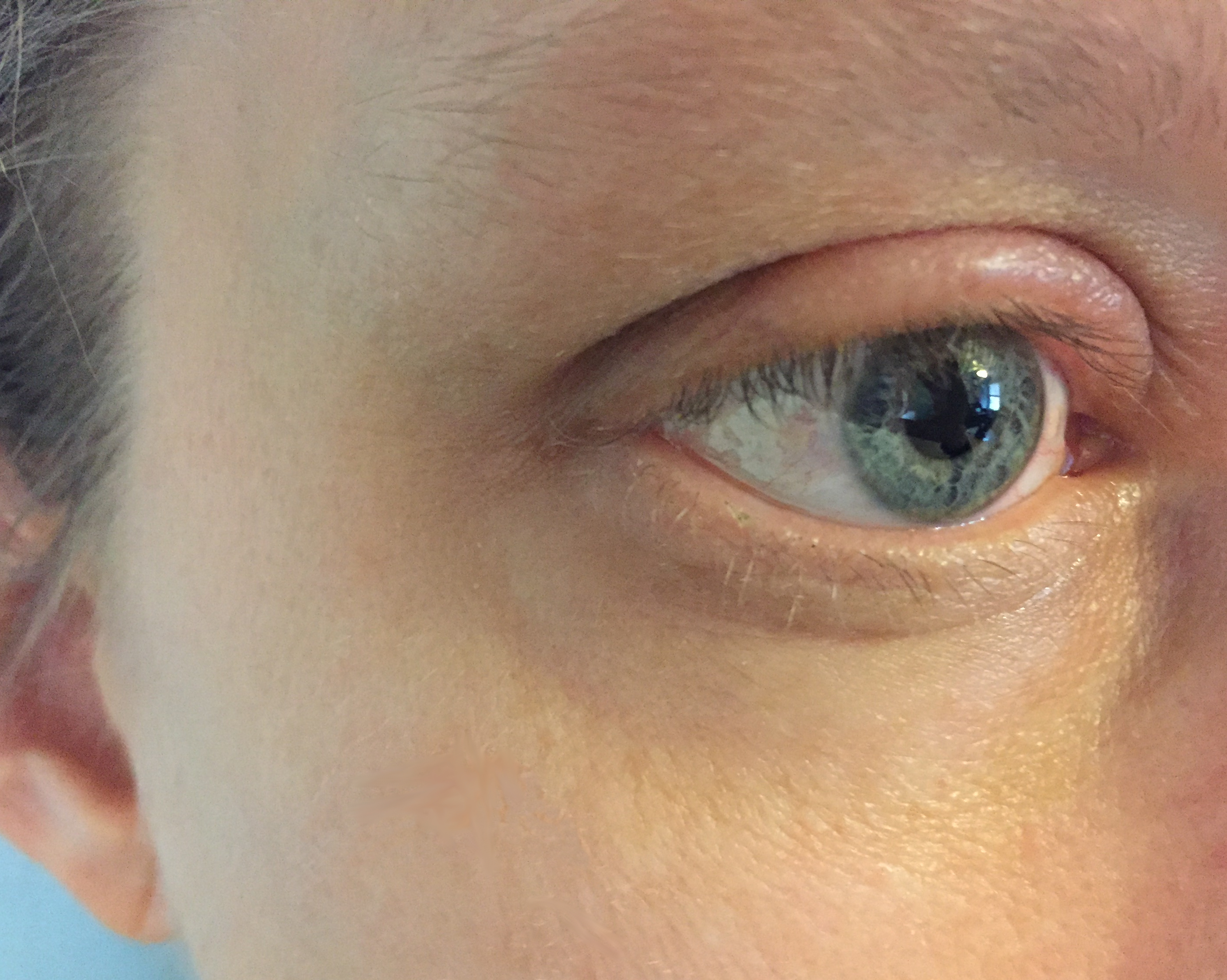 The Skin Health Crisis You Can Control (image credits: Swollen Eyelid Due to Allergy, CC BY 2.0, https://commons.wikimedia.org/w/index.php?curid=82983648)