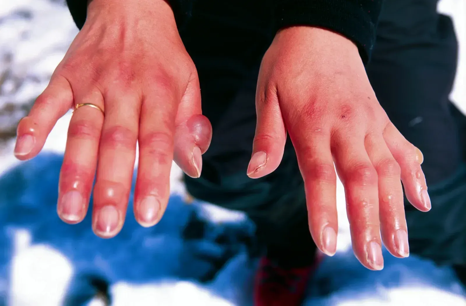 Frostbite Moves Faster Than You Think (Flickr, CC BY 2.0)