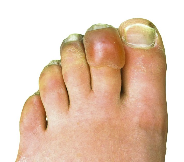 Frostbite Prevention and Treatment (image credits: wikimedia)