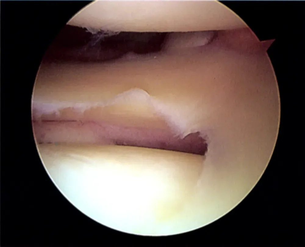 #8 - The Meniscus (By Tim1965, CC BY-SA 3.0)