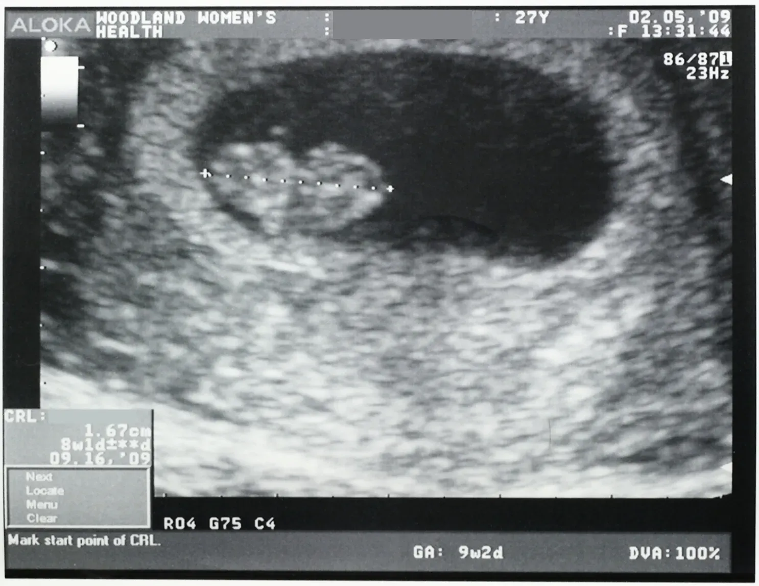 #6: Ultrasound Images Rewriting Early Pregnancy Assumptions (By Ragesoss, CC BY-SA 3.0)