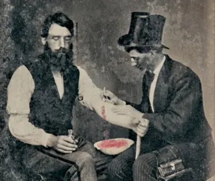 #5 - Bloodletting Was "Proven" Medicine for Over 2,000 Years (Burns Archive via Newsweek, 2.4.2011., Public domain)
