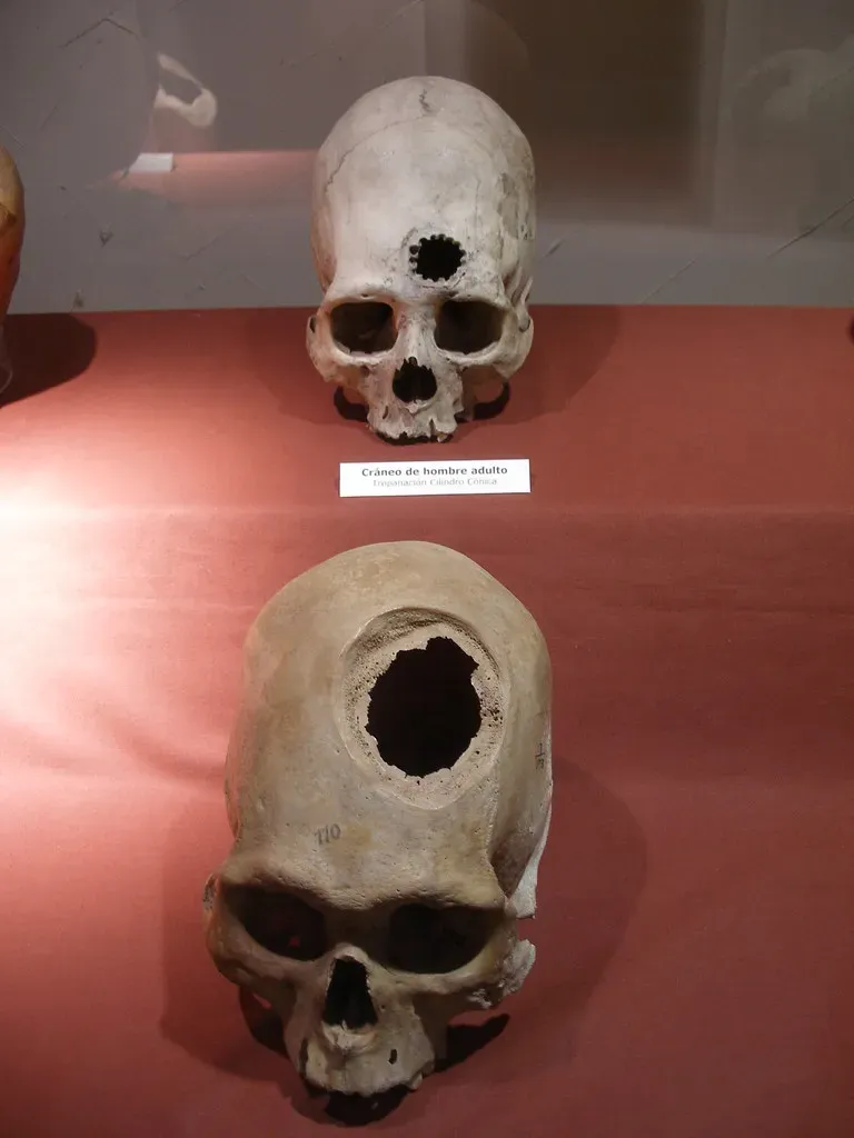 What It Actually Means When Bone Heals Over a Skull Wound (quinet, Flickr, CC BY 2.0)