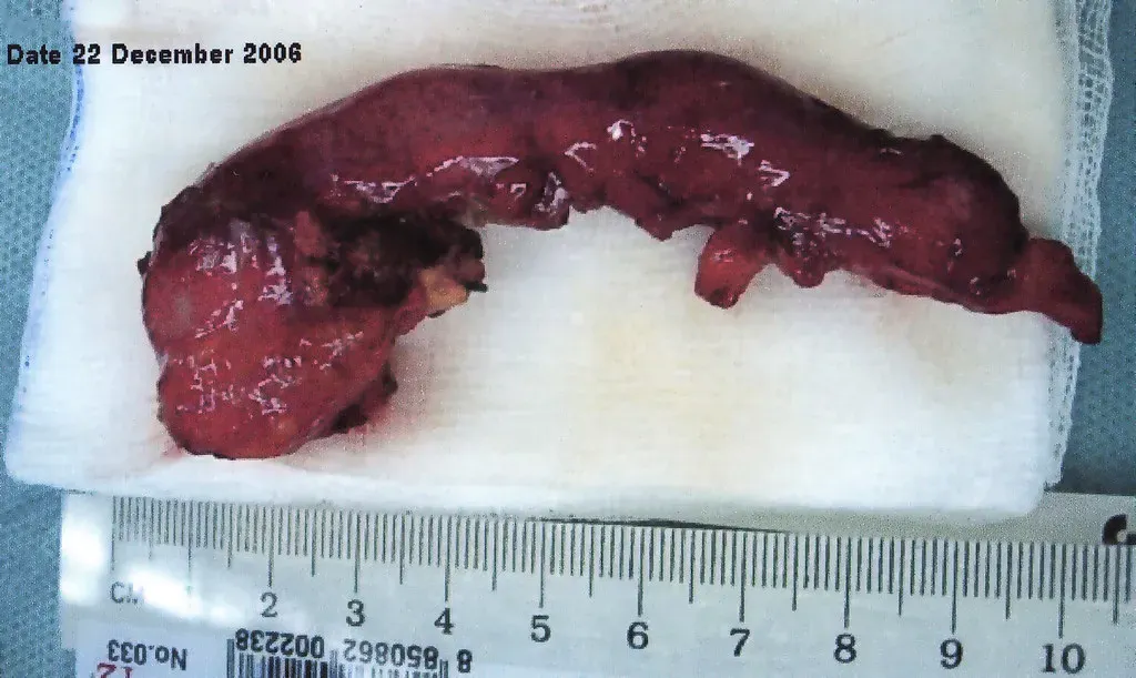 #14 - Your Appendix Is Just Evolutionary Junk (VMOS, Flickr, CC BY 2.0)