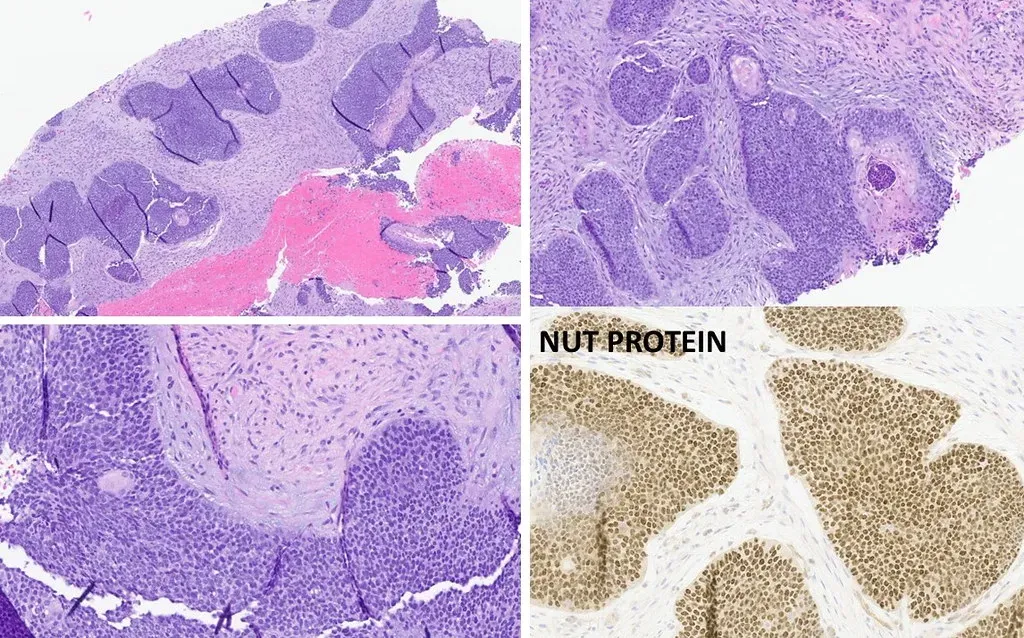 #2 - Your Chromosomes Carry a Genetic Fingerprint of Ancient Ape Ancestry (Pulmonary Pathology Society, Flickr, CC BY-SA 2.0)