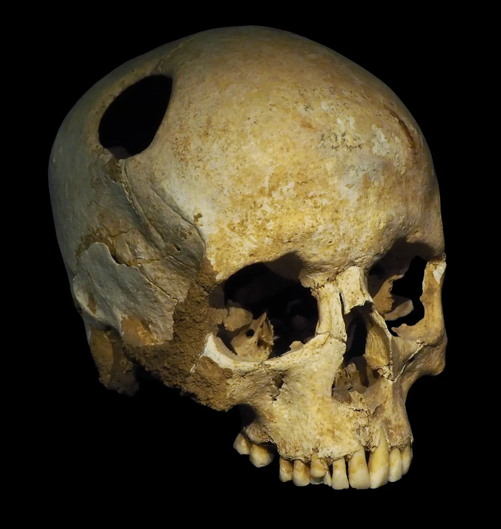 Prehistoric Surgery and Neuroscience: Skulls That Should Not Have Survived (Image Credits: Wikimedia)