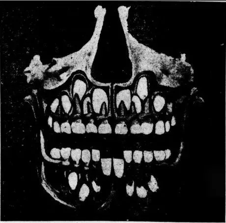 #4 - Teeth Attached to the Skull Can Narrow Age Down to the Year (The Tacoma Times (http://chroniclingamerica.loc.gov/lccn/sn88085187/1910-03-22/ed-1/seq-6/), Public domain)